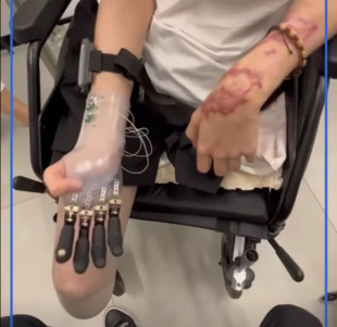 Dominik Hołuj robi duże postępy w rehabilitacji. Przetestował protezę ręki [WIDEO]