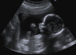 Nie dla aborcji. Będą pikietować 